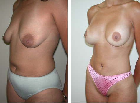 Best Breast Lift in Los Angeles